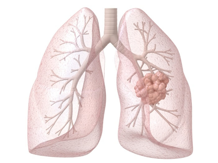 malignant pleural mesothelioma an update on investigation diagnosis and treatment